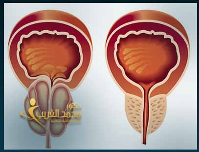 اورام ليفية